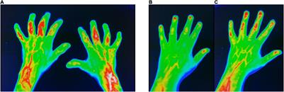 Follow-Up Comparison of Fluorescence Optical Imaging With Musculoskeletal Ultrasound for Early Detection of Psoriatic Arthritis